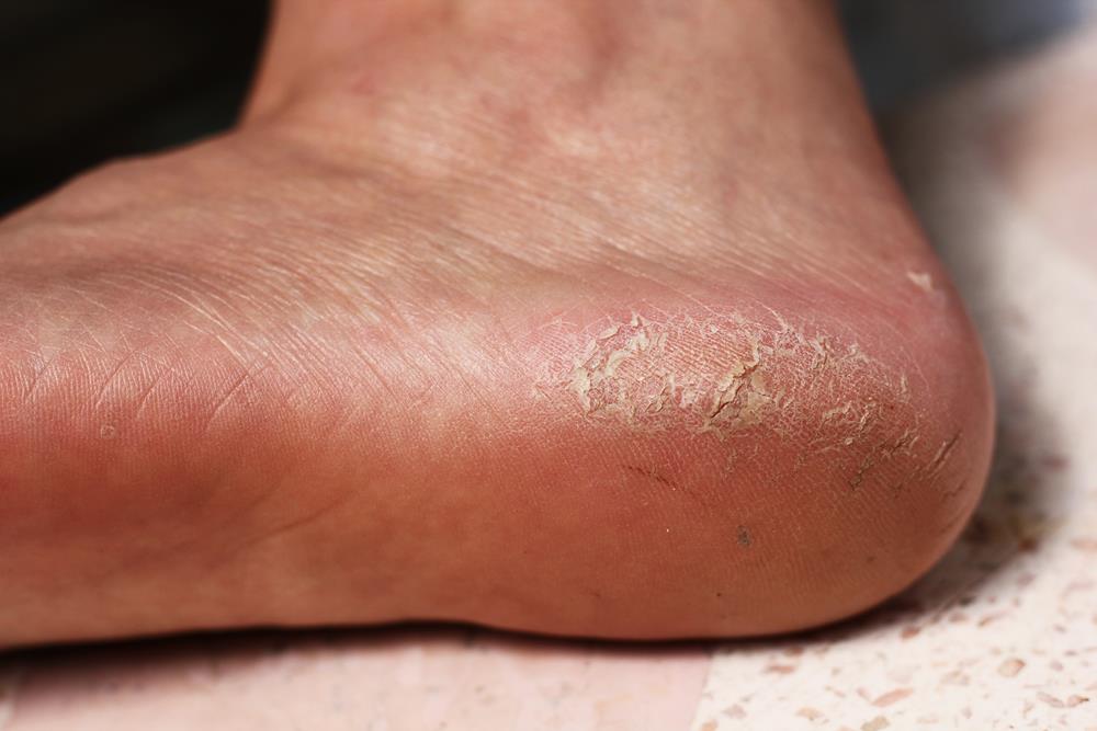 Calluses Augusta, GA